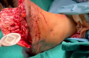 Trans-Metatarus Amputation Left Foot: Musculo-Cutaneous Flap Preparation with EZDeride (Sharp Debridement) Performed in the Operating Room - Part 1