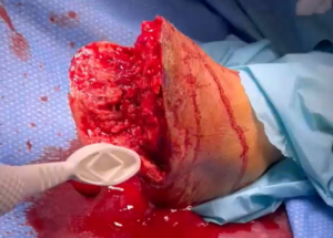 Trans-Metatarus Amputation Left Foot: Musculo-Cutaneous Flap Preparation with EZDeride (Sharp Debridement) Performed in the Operating Room - Part 2