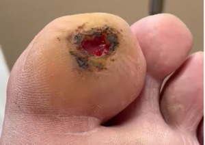 Diabetic Foot Ulceration Left Hallux with EZDebride Part 2